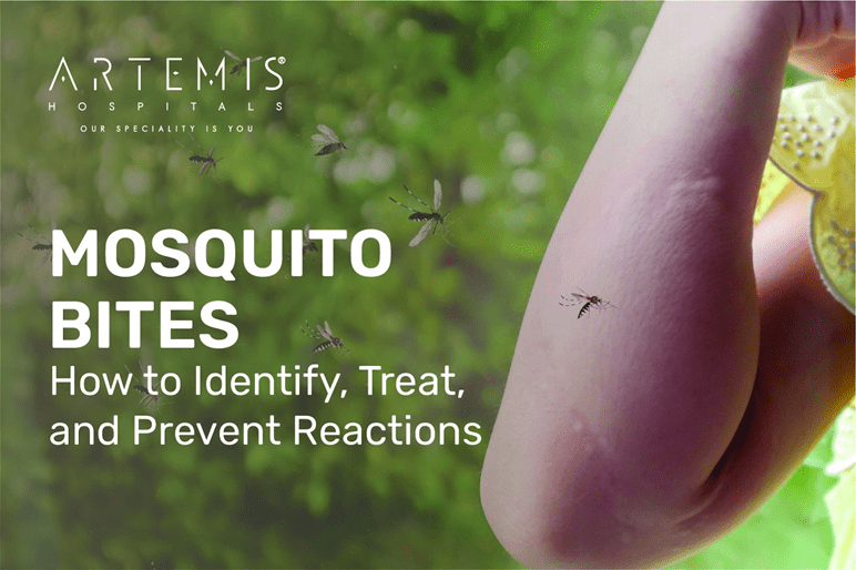 Mosquito Bites Symptoms