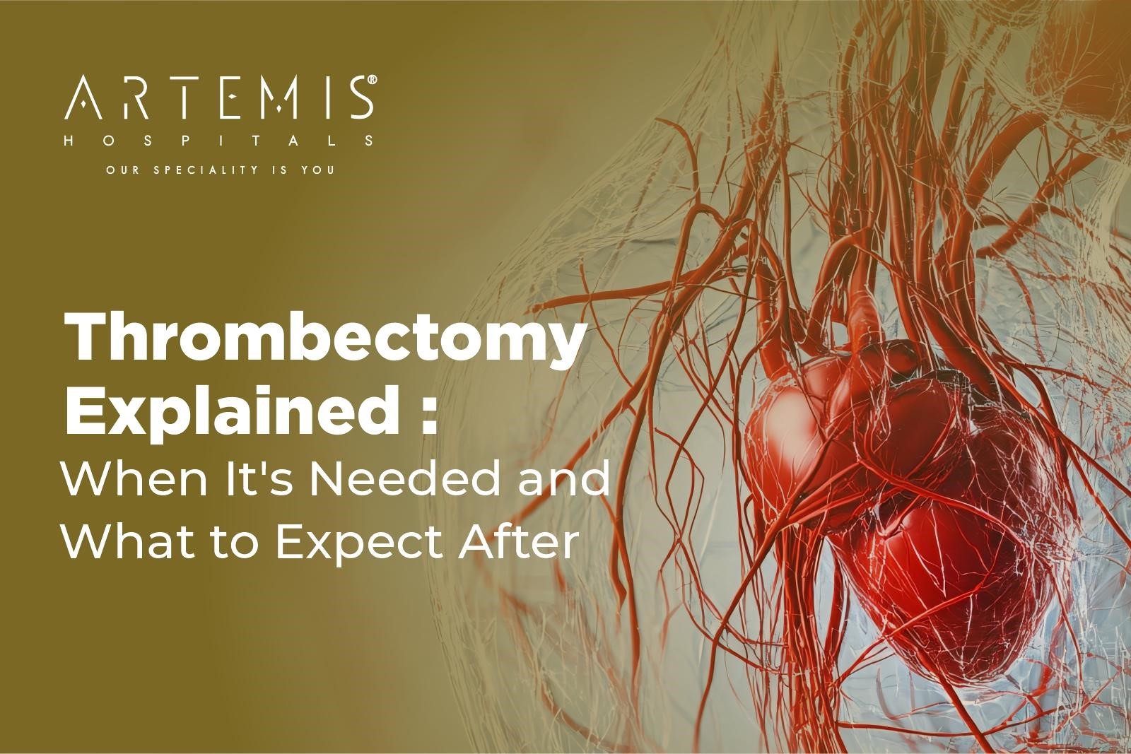 Thrombectomy